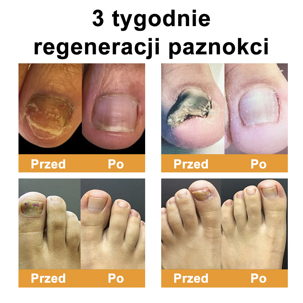 ☁️Természetes megoldás a körömgomba végleges eltávolítására ✨ Nincs szégyen, nincs vegyszer. Látható javulás*🔥