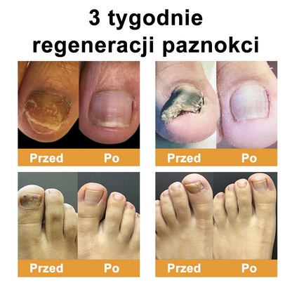 ☁️Természetes megoldás a körömgomba végleges eltávolítására ✨ Nincs szégyen, nincs vegyszer. Látható javulás*🔥