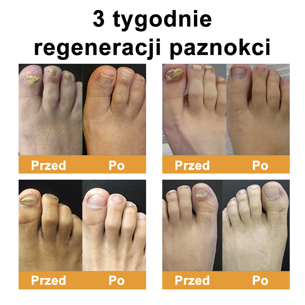 ☁️Természetes megoldás a körömgomba végleges eltávolítására ✨ Nincs szégyen, nincs vegyszer. Látható javulás*🔥